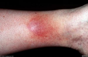 Stasis dermatitis, types of eczema, eczema