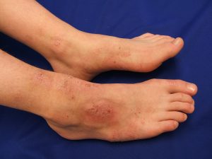 types of eczema, eczema, Atopic Dermatitis