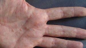 Dyshidrotic Eczema, types of eczema, eczema