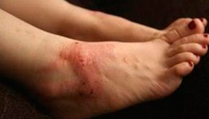 Contact Eczema, types of eczema, eczema