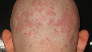 Seborrheic Eczema, types of eczema, eczema